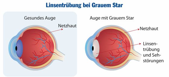 Grafik Grauer Star.